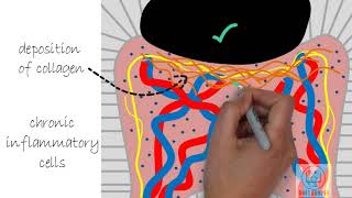 Chronic pulpitis  Diseases of pulp Part 4 [upl. by Calv659]