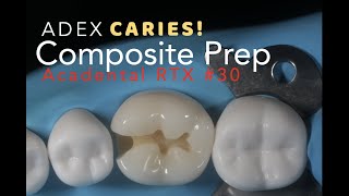 Class II Composite Preparation for ADEX Caries 30 MO [upl. by Starkey]