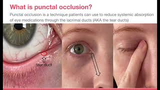 Punctal Occlusion [upl. by Eamon]