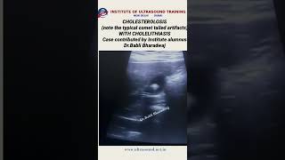 Cholesterolosis with cholelithiasis ultrasound ultrasoundlife pocus [upl. by Sarajane]