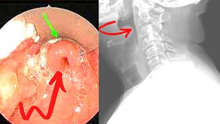 Epiglottitis Emergency Symptoms Causes Treatment [upl. by Mureil904]