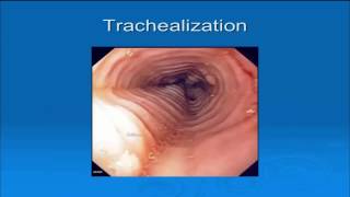 Eosinophilic Esophagitis Page [upl. by Auqenat260]