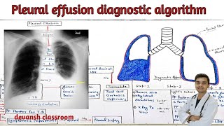 pleural effusion  approach  diagnostic algorithm  in Hindi [upl. by Norton590]