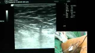 Operatie varice dr Feodor Toni Ablatia prin radiofrecventa VNUS Closure Fast part 2avi [upl. by Dawkins]