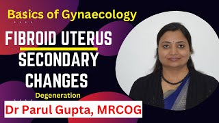 Fibroid uterus  Secondary changes  Degeneration [upl. by Heigho]