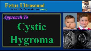 Fetus Ultrasound Cystic Hygroma [upl. by Airtap]