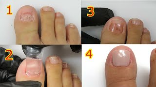 EASIEST Polygel Dual Form Toenail Ever Made For A Toe With NO NAIL  Fix Ugly Toes [upl. by Airtemad]