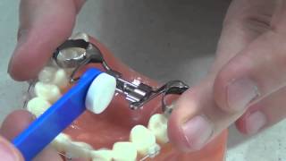 How do you turn your fixed orthodontic expander [upl. by Ntsuj]