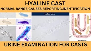 HYALINE CASTS IN URINECAUSES SYMPTOMS TREATMENT OF HYALINE CASTS IN URINE EXAMINATION IN HINDI [upl. by Willetta]