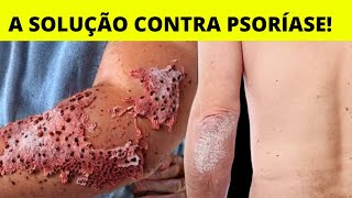 A MELHOR SOLUÇÃO CONTRA PSORÍASE  VEJA FOTOS DE ANTES X DEPOIS [upl. by Yrok]