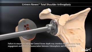 Univers Revers™ Total Shoulder Arthroplasty [upl. by Ellehsal389]