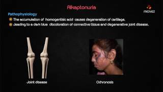 Ochronosis or Alkaptonuria  Usmle step 1 lecture [upl. by Accemahs62]