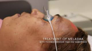 Treatment of melasma with the Picoway Resolve 1064532 nm hand piece [upl. by Nikaniki671]