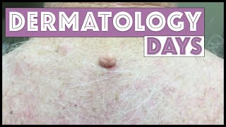 Dermatology Days  A sampling of patients I see in a day [upl. by Iak]