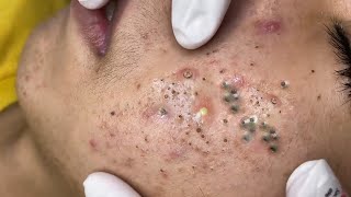 Big Cystic Acne Blackheads Extraction Blackheads amp Milia Whiteheads Removal Pimple Popping  3823 [upl. by Siuluj]