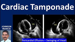 Cardiac Tamponade [upl. by Ursuline]