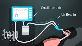 How ventilators work and why we need them to fight covid19 [upl. by Pickett]