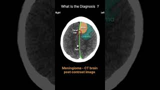 Meningioma CT brainpost contrast image Acute CT Brain Intracranial masses75radiologychannel007 [upl. by Ahsikad]