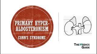 Primary Hyperaldosteronism Conns Syndrome [upl. by Ttimme151]