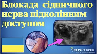 Блокада сідничного нерва підколінним доступом 🇺🇦 Popliteal Sciatic Nerve Block [upl. by Zertnom510]