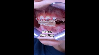 In Cosmetic Jaw Surgery  Why Braces Treatment is a Must orthognathicsurgery cosmeticsurgery [upl. by Meda232]