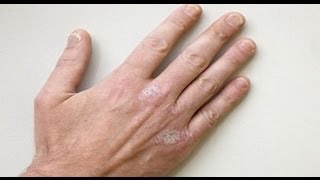 Causes and Remedies of Psoriasis  Nabz  Homeopathy Specialist  Dr Zahid Noorani [upl. by Onaicram]