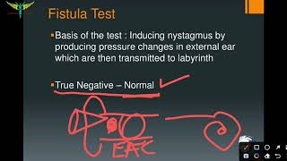 Fistula test  ENT  Tests for Vestibular functions [upl. by Annayi]