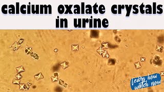 Identify Calcium Oxalate Crystals in Urine  Microscopic view of Calcium Oxalate crystals [upl. by Shyamal]