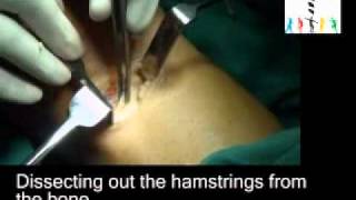 Hamstring graft harvesting by Dr Raju Easwaran [upl. by Corene]