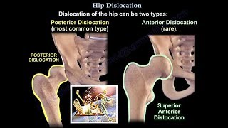 Dislocation of the hip  Everything You Need To Know  Dr Nabil Ebraheim [upl. by Angy]