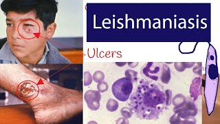 Leishmaniasis  Symptoms and Treatment of Leishmaniasis Explained under 3 minutes [upl. by Genevieve]