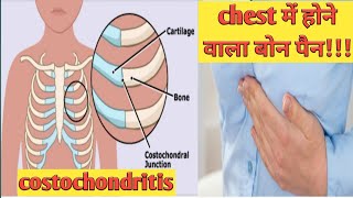 Orthopedic Chest Pain Costochondritis in Hindi  Teitze Syndrome IN Hindi [upl. by Rednaxela965]