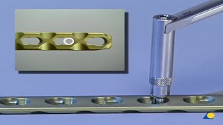 Technique  Locking Compression Plate LCP Application [upl. by Behka910]