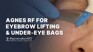 NonSurgical Eye Bag Treatment and Brow Lift  Agnes RF [upl. by Oneill347]