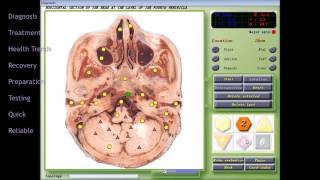 BioResonance NLS Diagnosis and Treatment Computer System MEDICOMAT36 7DNLS [upl. by Wyatan]