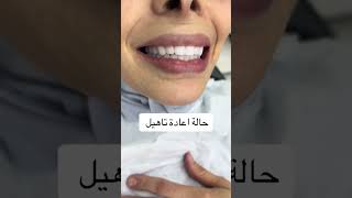 تجميل الاسنانdrteethdento اكسبلور genshinimpactmusic dentist [upl. by Nilsoj]