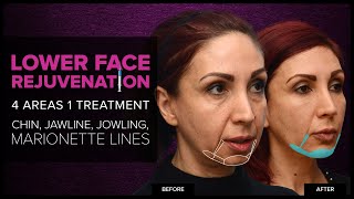 Lower Face Rejuvenation Chin Jawline amp Jowls With Dermal Fillers at Mabrie Facial Institute [upl. by Verger]