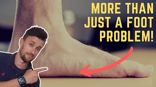 Why Flat Feet Are More Than Just a Foot Problem [upl. by Onitselec116]