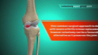 Osteotomy Animation i [upl. by Sella]