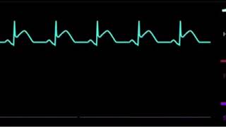 Taquicardia sinusal com elevação de ST  ECG [upl. by Duvall753]