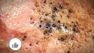 Most Satisfying CloseUp Blackhead Removal 2024 [upl. by Hairaza]