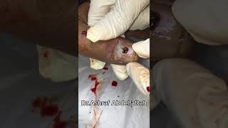 subungual hematoma تجمع دموي تحت الاصبع [upl. by Yerxa]