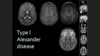 How to think about Diagnosis in the Leukodystrophies in 2020 [upl. by Uda]