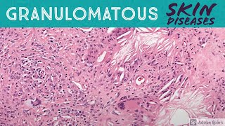 Granulomatous Skin Diseases 101 Dermpath Basics for Dermatology Pathology amp USMLE [upl. by Elset]