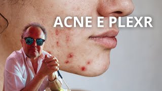 Acne e Plexr Come funziona e quali risultati aspettarsi [upl. by Bertsche]