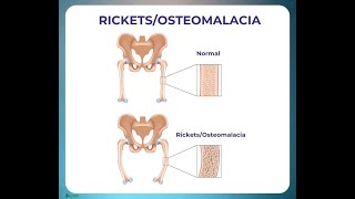 What is the Vitamin Deficiency in Osteomalacia Vitamin D Deficiency [upl. by Mongeau]