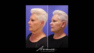 67YearOld Patient Mini FaceNecklift Results  Avance Plastic Surgery Institute Dr Erez Dayan [upl. by Estrellita173]