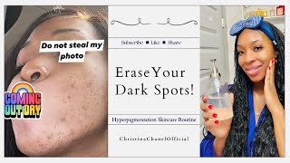 Is hyperpigmentation ruining your life [upl. by Nehgem]