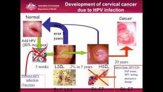 Cervical Cancer Screening Is this the end of the pap smear [upl. by Letty]