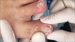 Beautiful satisfying ingrown toenail removal ❤❤❤❤ funny satisfying 058 [upl. by Alicsirp169]